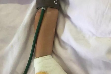 淮安2岁女童将金属饭叉插入接线板被“电飞”，左手受损严重